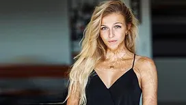 «&nbsp;Je suis restée dans le coma trois mois, je pesais 32 kilos quand je me suis réveillée&nbsp;»&nbsp;: le récit bouleversant de Julie, grande brûlée à l’âge de 16 ans