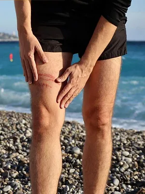 Alerte aux méduses