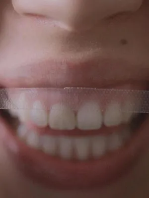 Des dents blanches... au rire jaune !